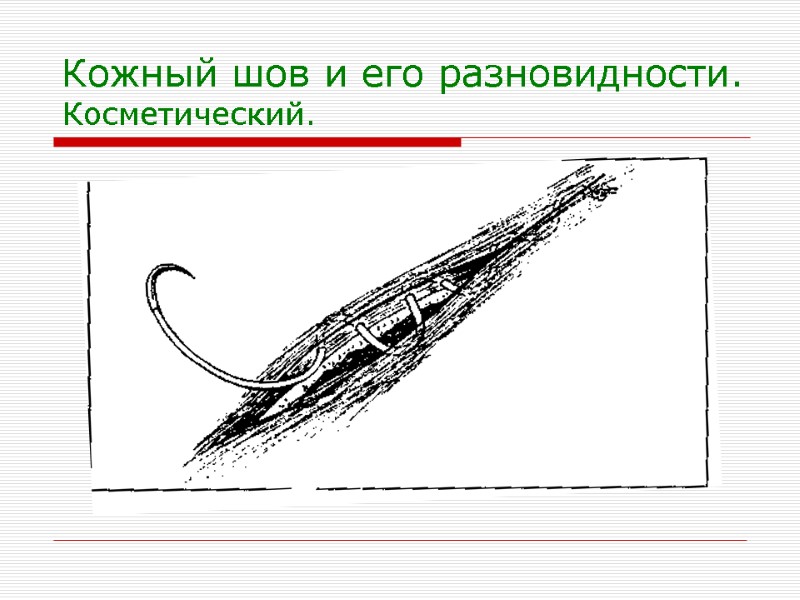 Кожный шов и его разновидности. Косметический.